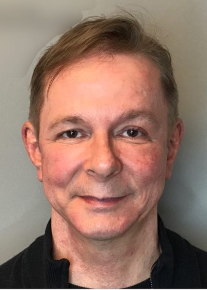 Bellafill Before & After Patient #65