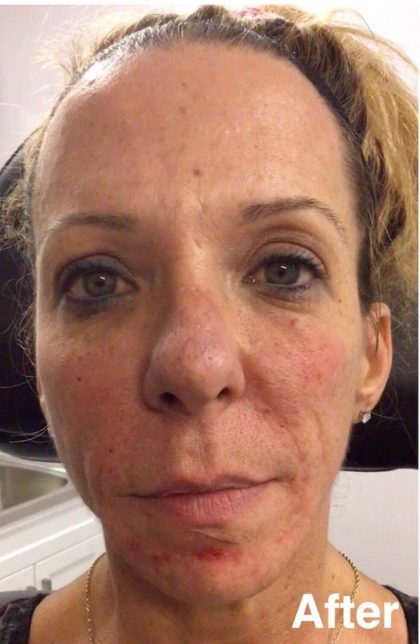 Bellafill Before & After Patient #62