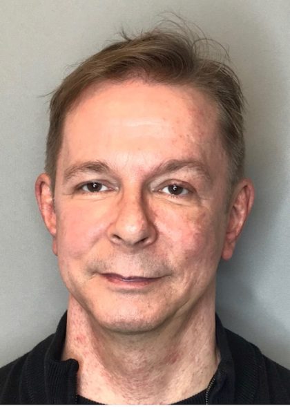 Bellafill Before & After Patient #65