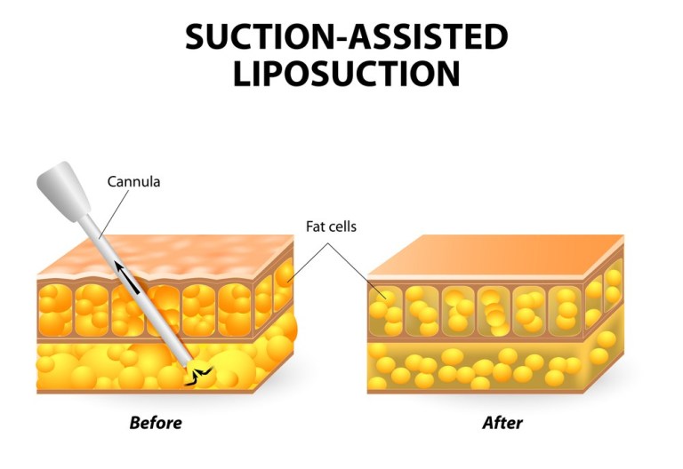 1760118761_liposuction