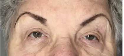 After Image: Blepharoplasty - front