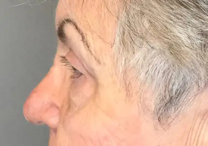 After Image: Blepharoplasty - left-side