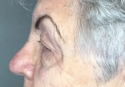 Before Image: Blepharoplasty - left-side