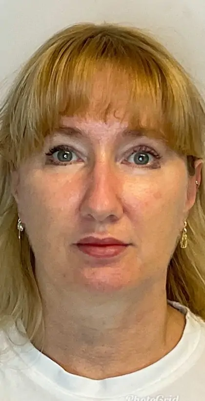 After Image: Blepharoplasty - front
