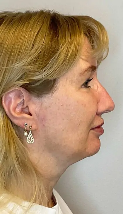 After Image: Blepharoplasty - right-side