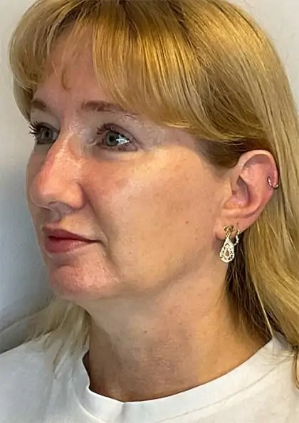 After Image: Blepharoplasty - left-front-oblique