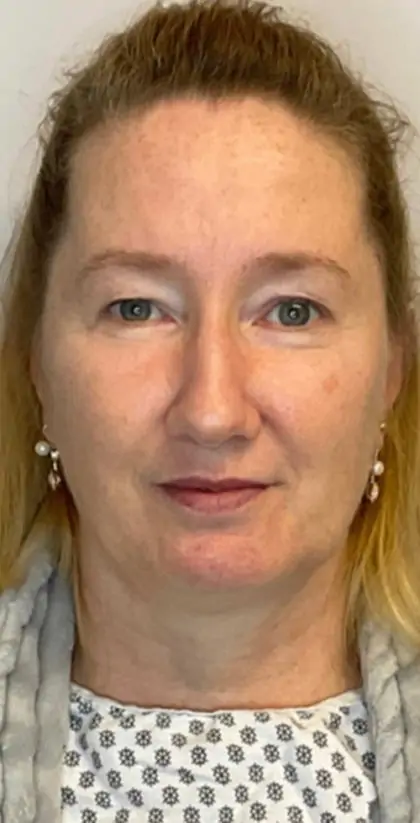 Before Image: Blepharoplasty - front