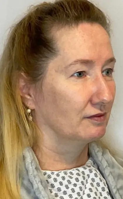 Before Image: Blepharoplasty - right-front-oblique