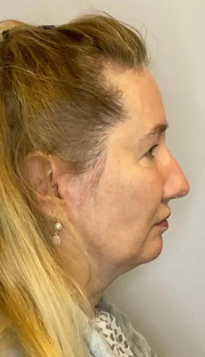 Before Image: Blepharoplasty - right-side