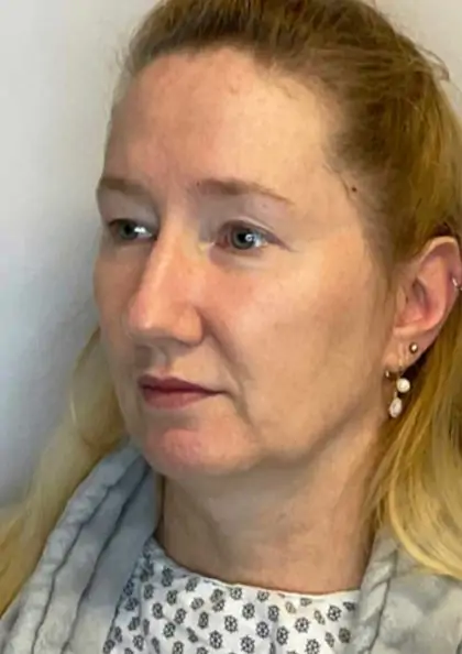 Before Image: Blepharoplasty - left-front-oblique