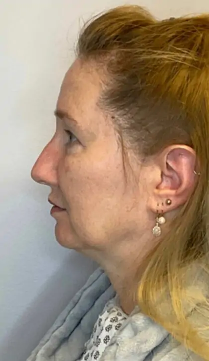 Before Image: Blepharoplasty - left-side