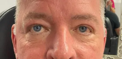 After Image: Blepharoplasty - front