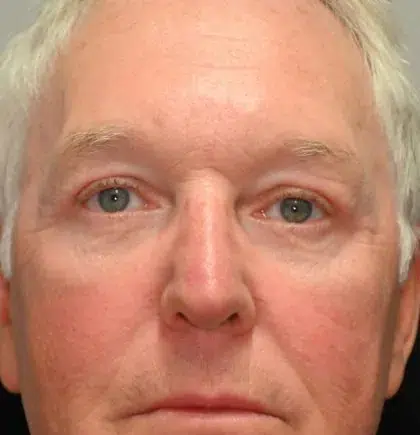 After Image: Blepharoplasty - front