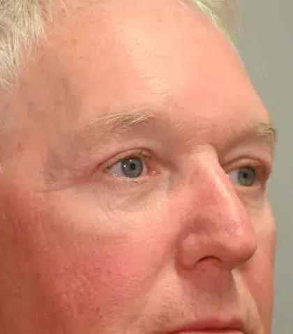 After Image: Blepharoplasty - right-front-oblique