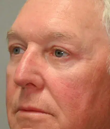 After Image: Blepharoplasty - left-front-oblique