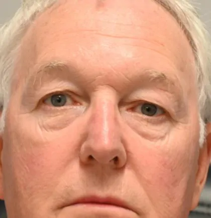 Before Image: Blepharoplasty - front