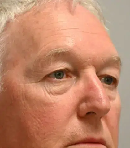 Before Image: Blepharoplasty - right-front-oblique