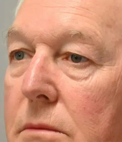 Before Image: Blepharoplasty - left-front-oblique