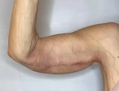 After Image: Brachioplasty - front