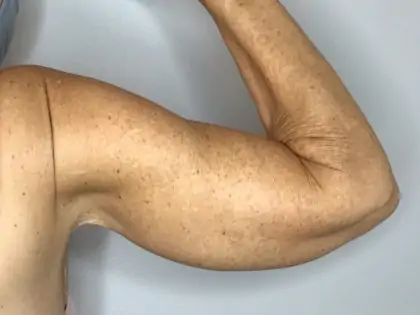 After Image: Brachioplasty - back