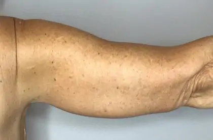 After Image: Brachioplasty - back