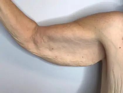 Before Image: Brachioplasty - front