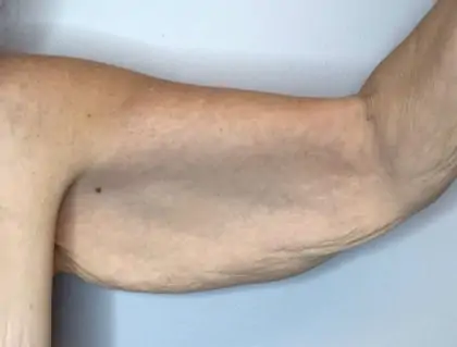 Before Image: Brachioplasty - front