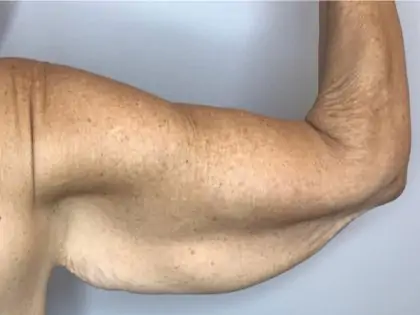 Before Image: Brachioplasty - back