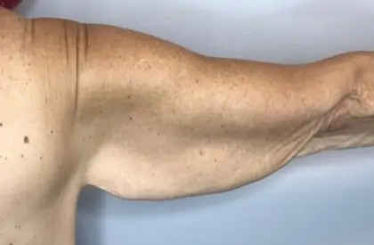 Before Image: Brachioplasty - back