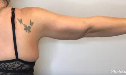 After Image: Brachioplasty - back