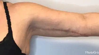 After Image: Brachioplasty - front