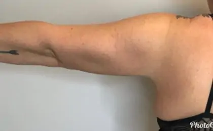 After Image: Brachioplasty - back