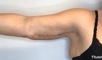 After Image: Brachioplasty - front