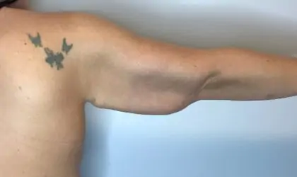 Before Image: Brachioplasty - back