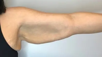 Before Image: Brachioplasty - front