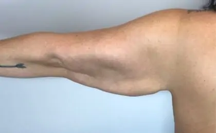 Before Image: Brachioplasty - back
