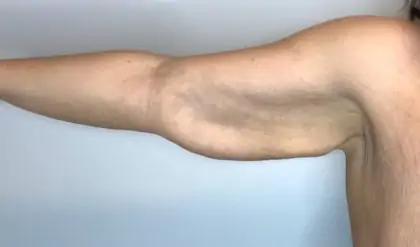 Before Image: Brachioplasty - front