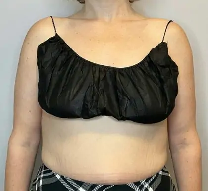 After Image: Brachioplasty - front