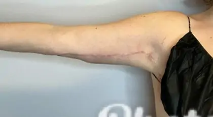 After Image: Brachioplasty - front