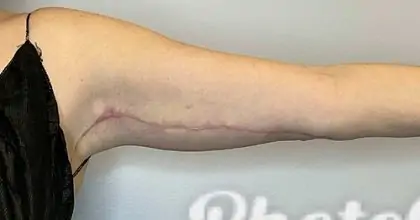After Image: Brachioplasty - front