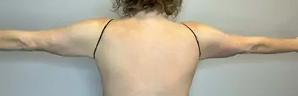 After Image: Brachioplasty - back