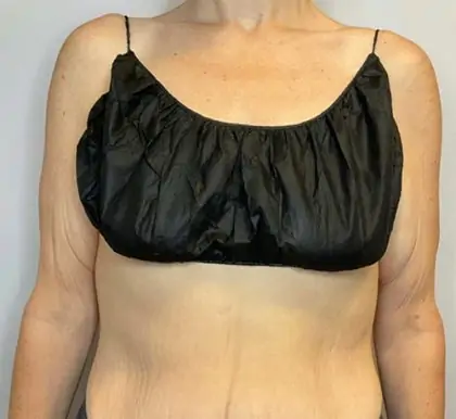 Before Image: Brachioplasty - front