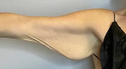 Before Image: Brachioplasty - front