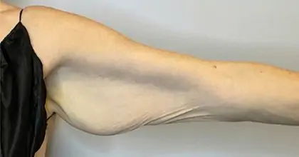 Before Image: Brachioplasty - front