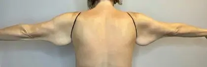 Before Image: Brachioplasty - back