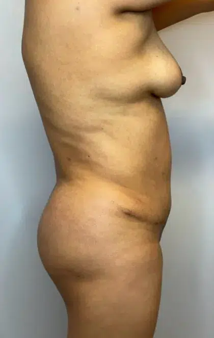 After Image: Brazilian Butt Lift, Liposuction, Tummy Tuck - right-side