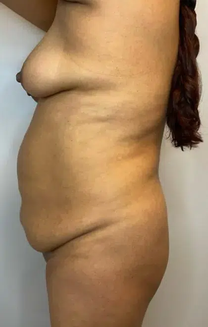 Before Image: Brazilian Butt Lift, Liposuction, Tummy Tuck - left-side