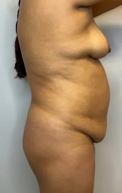 Before Image: Brazilian Butt Lift, Liposuction, Tummy Tuck - right-side