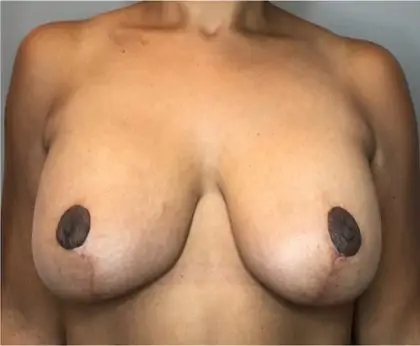 After Image: Breast Augmentation - front