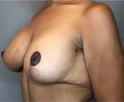After Image: Breast Augmentation - left-front-oblique